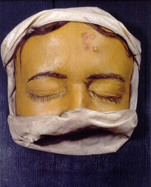Moulage „Lues papulosa“ aus der Sammlung des Deutschen Hygiene-Museum, um 1920, DHMD Moulage „Lues papulosa“ aus der Sammlung des Deutschen Hygiene-Museum, um 1920, DHMD